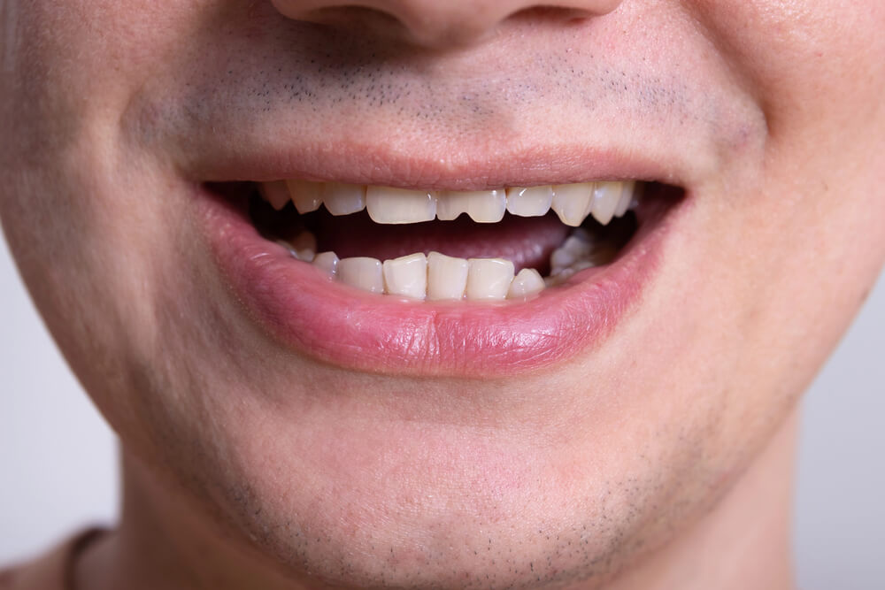 Is a chipped tooth an emergency?